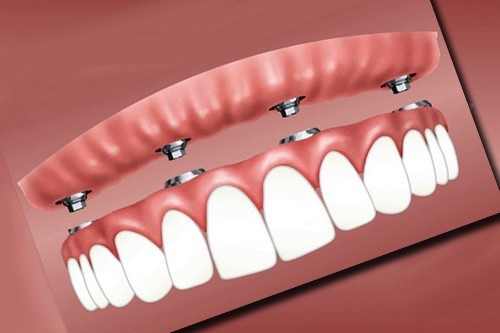 ایمپلنت دندان برای چه کسانی است + عوراض و مزایا در سال 2022