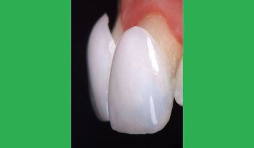 مزایای روکش دندان چیست 
