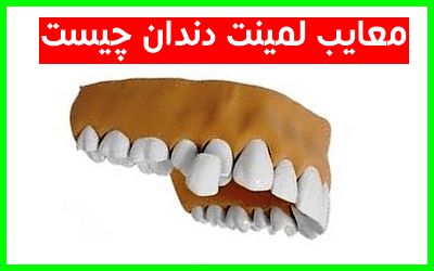 معایب لمینت دندان چیست