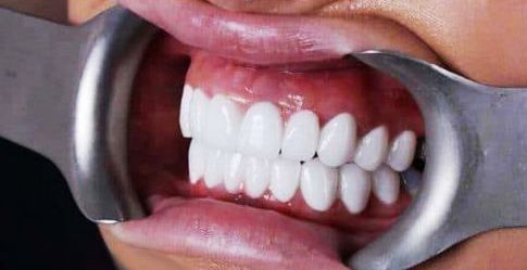 چه افرادی  مناسب برای روکش دندان هستند