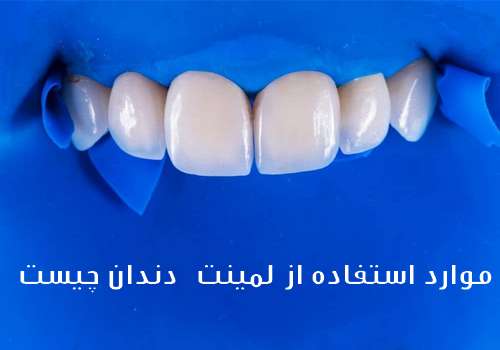 موارد استفاده از لمینت دندان چیست