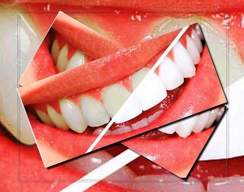 چیکار لمینت دندان زرد زرد نشه