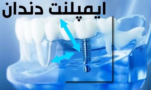 ایمپلنت دندان  چند روز طول میکشد