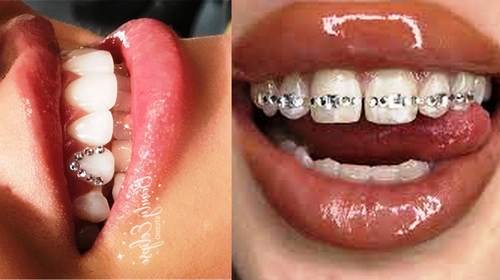 روش  نصب نگین دندان در مطب چگونه است