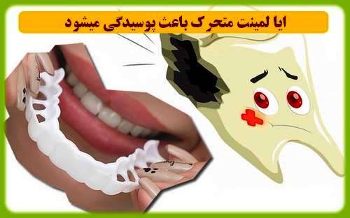 ایا لمینت متحرک باعث پوسیدگی میشود