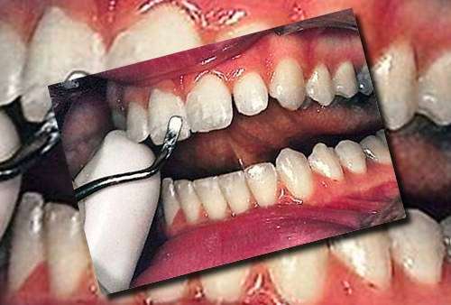 دندان  پوسیده چگونه لمینت میشود 