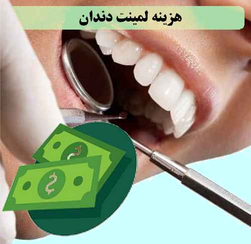 هزینه لمینت دندان چقدر میشود