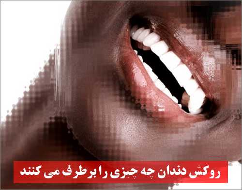 روکش دندان چه چیزی را برطرف می کنند