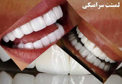 لمینت سرامیکی